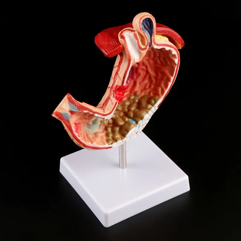 Human Anatomical Anatomy Stomach Model Gastric Pathology Gastritis Ulcer Teaching Learning Tool
Human Anatomical Anatomy Stomach Model Gastric Pathology Gastritis Ulcer Teaching Learning Tool