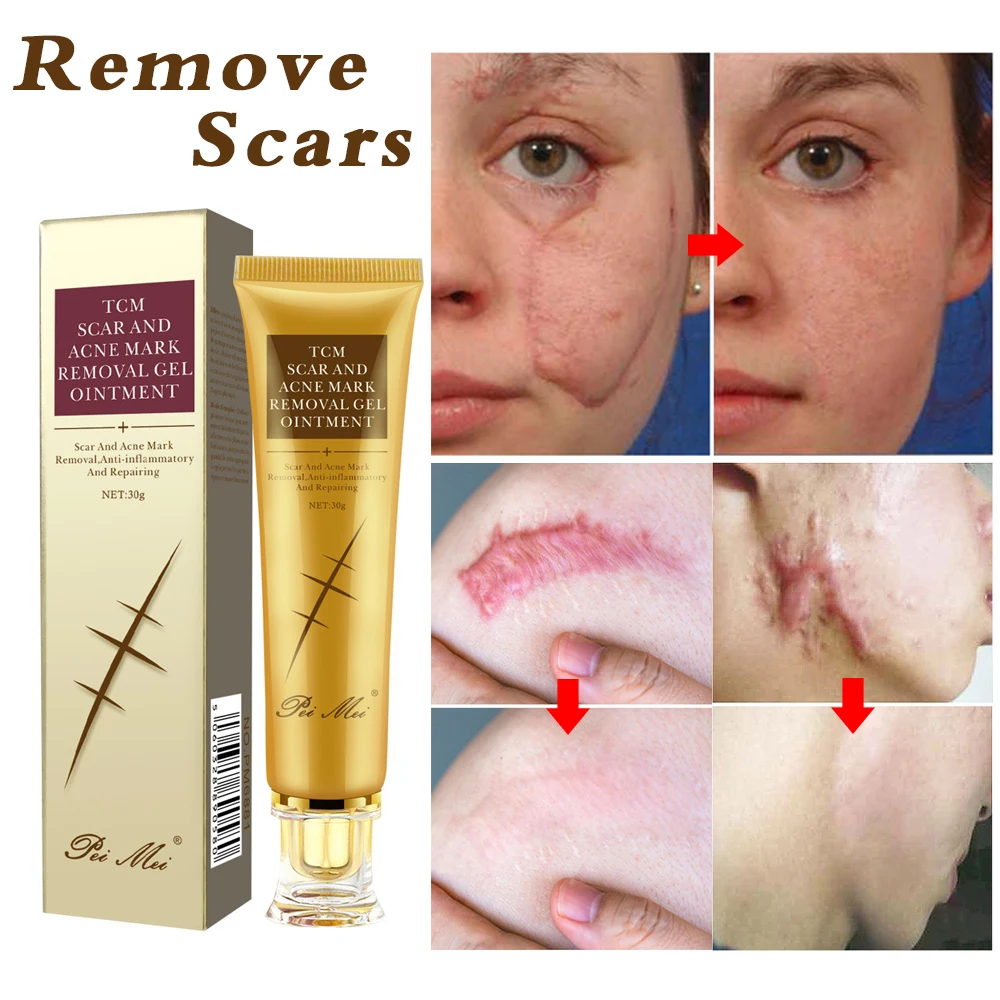 Stretch Marks Remove Acne Scar Treatment Cream Face Whitening Cream Pimple Scar Pregnancy Nourish Postpartum Body Skin Cream 30g
Stretch Marks Remove Acne Scar Treatment Cream Face Whitening Cream Pimple Scar Pregnancy Nourish Postpartum Body Skin Cream 30g
