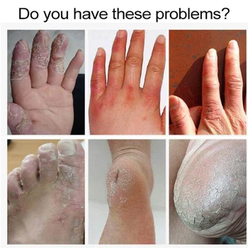 Chinese Medicinal Ointment Hand Foot Crack Cream Heel Chapped Peeling Repair Frostbite Anti Dry Crack Skin Creams Wholesale
Chinese Medicinal Ointment Hand Foot Crack Cream Heel Chapped Peeling Repair Frostbite Anti Dry Crack Skin Creams Wholesale
