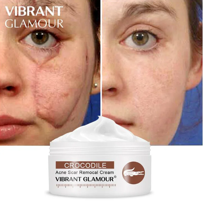 VIBRANT GLAMOUR Crocodile Repair Scar cream Removal Acne Scar Treatment Stretch Marks Burn Whitening Knife scar Skin Care new
VIBRANT GLAMOUR Crocodile Repair Scar cream Removal Acne Scar Treatment Stretch Marks Burn Whitening Knife scar Skin Care new