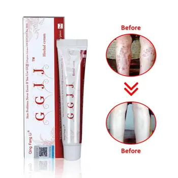 Psoriasis Cream Body Massage Patches Anti Eczeem Psoriasis Cream Works Perfect Relieve All Skin Problems For itching patch
Psoriasis Cream Body Massage Patches Anti Eczeem Psoriasis Cream Works Perfect Relieve All Skin Problems For itching patch