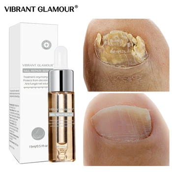 VIBRANTGLAMOUR Fungal Nail Treatment Feet Care Serum Nail Foot Nail Fungus Removal Gel Anti Infection Paronychia
VIBRANTGLAMOUR Fungal Nail Treatment Feet Care Serum Nail Foot Nail Fungus Removal Gel Anti Infection Paronychia