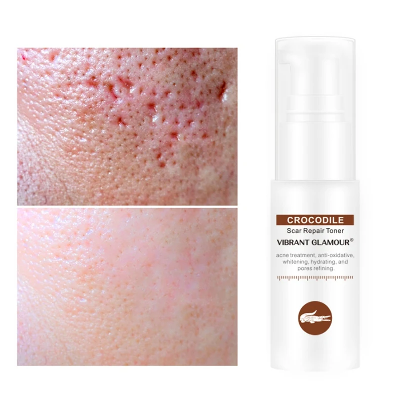 Crocodile Scar Repair Face Serum Acne Scar Removal Whitening Dark Spots Stretch Marks Treatment Skin Care Hot Sale 2019
Crocodile Scar Repair Face Serum Acne Scar Removal Whitening Dark Spots Stretch Marks Treatment Skin Care Hot Sale 2019