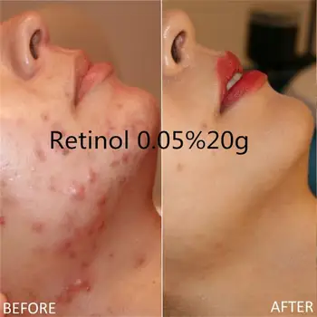 New retinol vitamin A Cream Anti Acne Acne anti wrinkle light spot physiotherapy cream 20g
New retinol vitamin A Cream Anti Acne Acne anti wrinkle light spot physiotherapy cream 20g