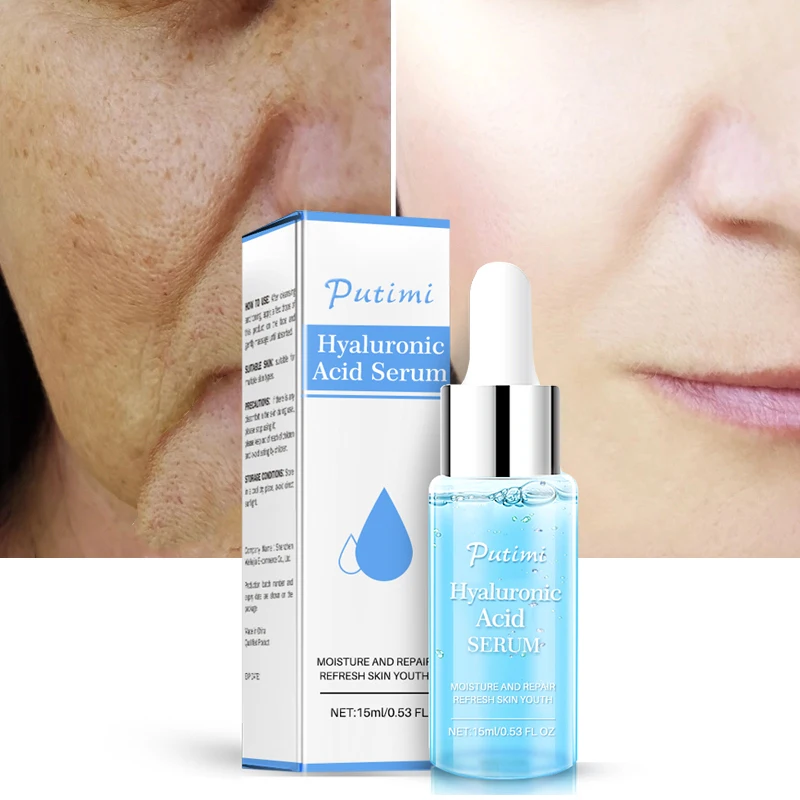 bleaching hyperpigmentation on face