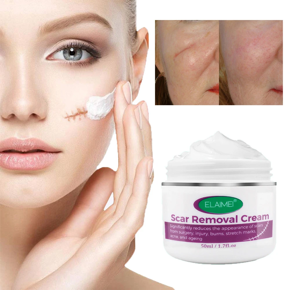 Scar Removal Cream For Acne Marks Burns Stretch Surgical Scars Promote New Skin Growth Treatment | Красота и здоровье