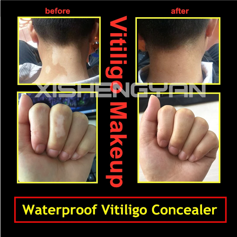 How To Cover Vitiligo Patches-Waterproof Fade Skin Leucoderma Concealer Timely Long-lasting Camouflage Vitiligo Makeup 2 pcs/lot
How To Cover Vitiligo Patches-Waterproof Fade Skin Leucoderma Concealer Timely Long-lasting Camouflage Vitiligo Makeup 2 pcs/lot