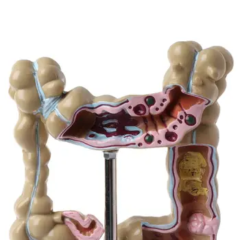 Human Colorectal Lesion Model Pathological Anatomy Colon Diseases Intestine Medical Teaching Learning Tool
Human Colorectal Lesion Model Pathological Anatomy Colon Diseases Intestine Medical Teaching Learning Tool