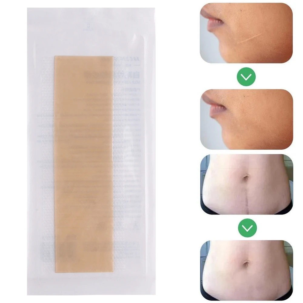 Scar Treatment Silicone Removal Patch Tape Sheets Efficient Surgery Gel Scar Therapy Acne Trauma Burn Scar Cover Skin Repair
Scar Treatment Silicone Removal Patch Tape Sheets Efficient Surgery Gel Scar Therapy Acne Trauma Burn Scar Cover Skin Repair