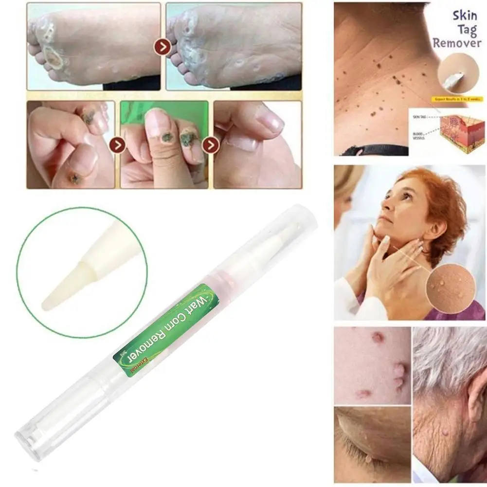 Genital Wart Treatment Papillomas Removal of Warts Against Removing Tags From Moles Wart Skin Remover Removal Liquid liuld P6M9
Genital Wart Treatment Papillomas Removal of Warts Against Removing Tags From Moles Wart Skin Remover Removal Liquid liuld P6M9