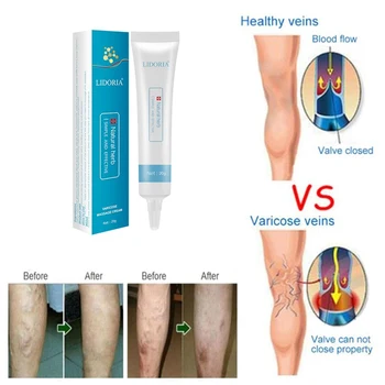 Varicose Veins Cream Promote Blood Circulation Relief Phlebitis Vasculitis Varicose Veins Treatment Ointment
Varicose Veins Cream Promote Blood Circulation Relief Phlebitis Vasculitis Varicose Veins Treatment Ointment