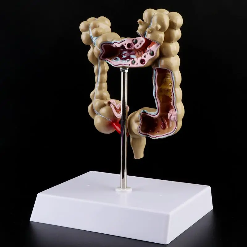 Human Colorectal Lesion Model Pathological Anatomy Colon Diseases Intestine Teaching Learning Tool
Human Colorectal Lesion Model Pathological Anatomy Colon Diseases Intestine Teaching Learning Tool