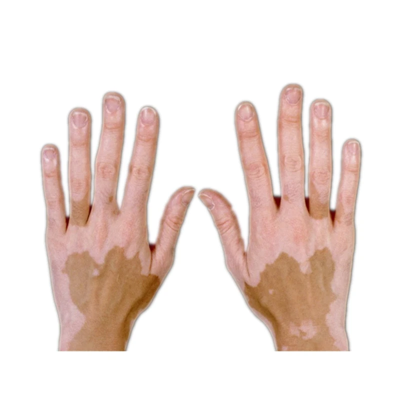 Leukoderma Covering Pen Waterproof Vitiligo Concealer Plant Essence Liquid for Body Face Hidden Discolored Skin Patches Makeup
Leukoderma Covering Pen Waterproof Vitiligo Concealer Plant Essence Liquid for Body Face Hidden Discolored Skin Patches Makeup
