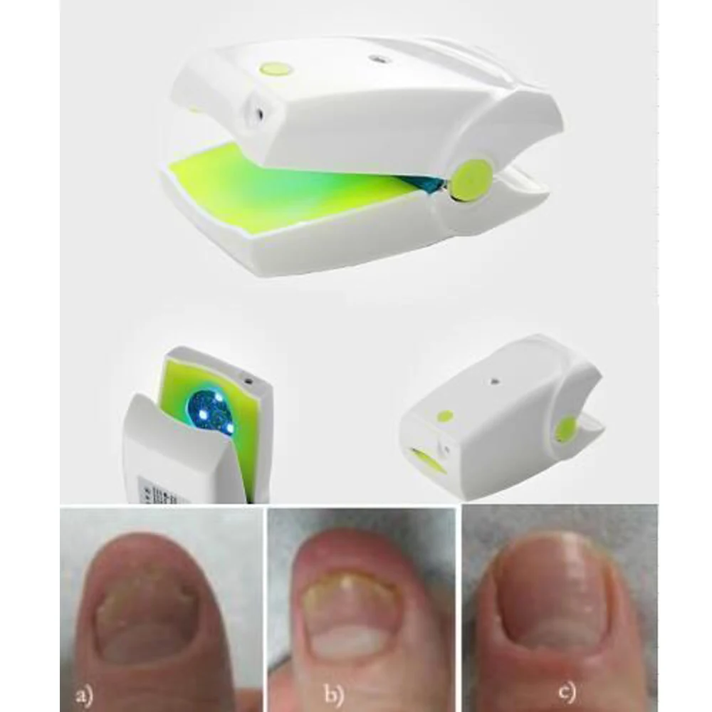 Nail Fungus Low Level Cold Laser Therapy Device Toenails Nails and Hand Nails Anti Fungal Onychomycosis Treatment Instrument CE
Nail Fungus Low Level Cold Laser Therapy Device Toenails Nails and Hand Nails Anti Fungal Onychomycosis Treatment Instrument CE