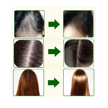 Professional Scalp Hair Nursing oil, Natural herbal Essence, prevents dandruff hair loss, White hair, Alopecia areata 
Professional Scalp Hair Nursing oil, Natural herbal Essence, prevents dandruff hair loss, White hair, Alopecia areata