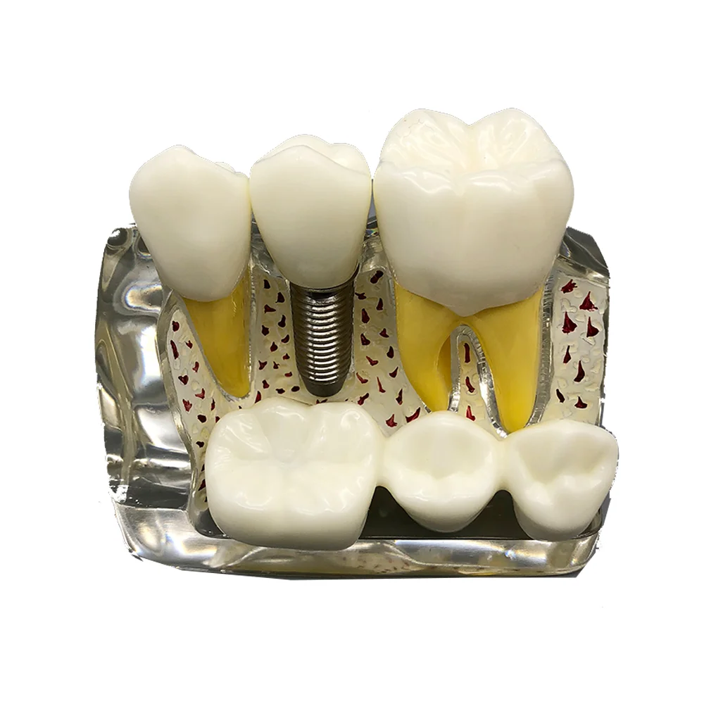 Transparent M2017T Teeth Model Dental Implant Teeth Model Dentist Dental Student Learning,Teaching,Research Communication
Transparent M2017T Teeth Model Dental Implant Teeth Model Dentist Dental Student Learning,Teaching,Research Communication