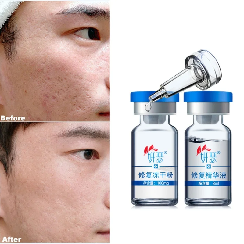 Freeze-dried Powder 3*100mg Scrum 3*3ml Solvent Essence Acne Elimination Acne Pit Acne Red Blood Silk Repair Facial Skin Essence
Freeze-dried Powder 3*100mg Scrum 3*3ml Solvent Essence Acne Elimination Acne Pit Acne Red Blood Silk Repair Facial Skin Essence