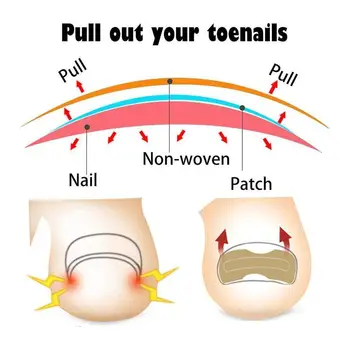 Ingrown Toenail Correction Sticker Paronychia Treatment Corrector Care Foot Toe Recover Tool Pedicure Nail Fixer V5W5 
Ingrown Toenail Correction Sticker Paronychia Treatment Corrector Care Foot Toe Recover Tool Pedicure Nail Fixer V5W5