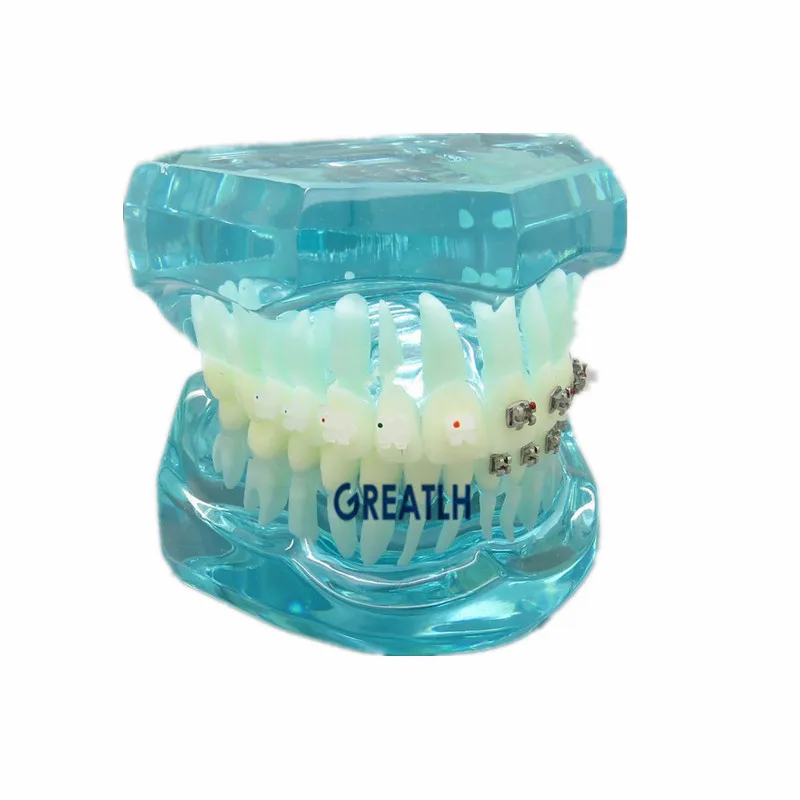 Dental Orthodontics treatment study model with Metal and Ceramic Brackets Teeth model Dental Teaching Model 
Dental Orthodontics treatment study model with Metal and Ceramic Brackets Teeth model Dental Teaching Model