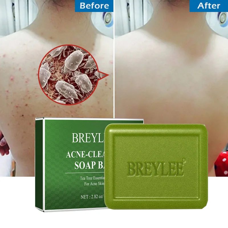 BREYLEE Acne Treatment Tea Tree Soap Bar Oil Control Cleans Moisturize Remove Blackhead Shrink Pore Face Body Dry Skin Care Bath
BREYLEE Acne Treatment Tea Tree Soap Bar Oil Control Cleans Moisturize Remove Blackhead Shrink Pore Face Body Dry Skin Care Bath