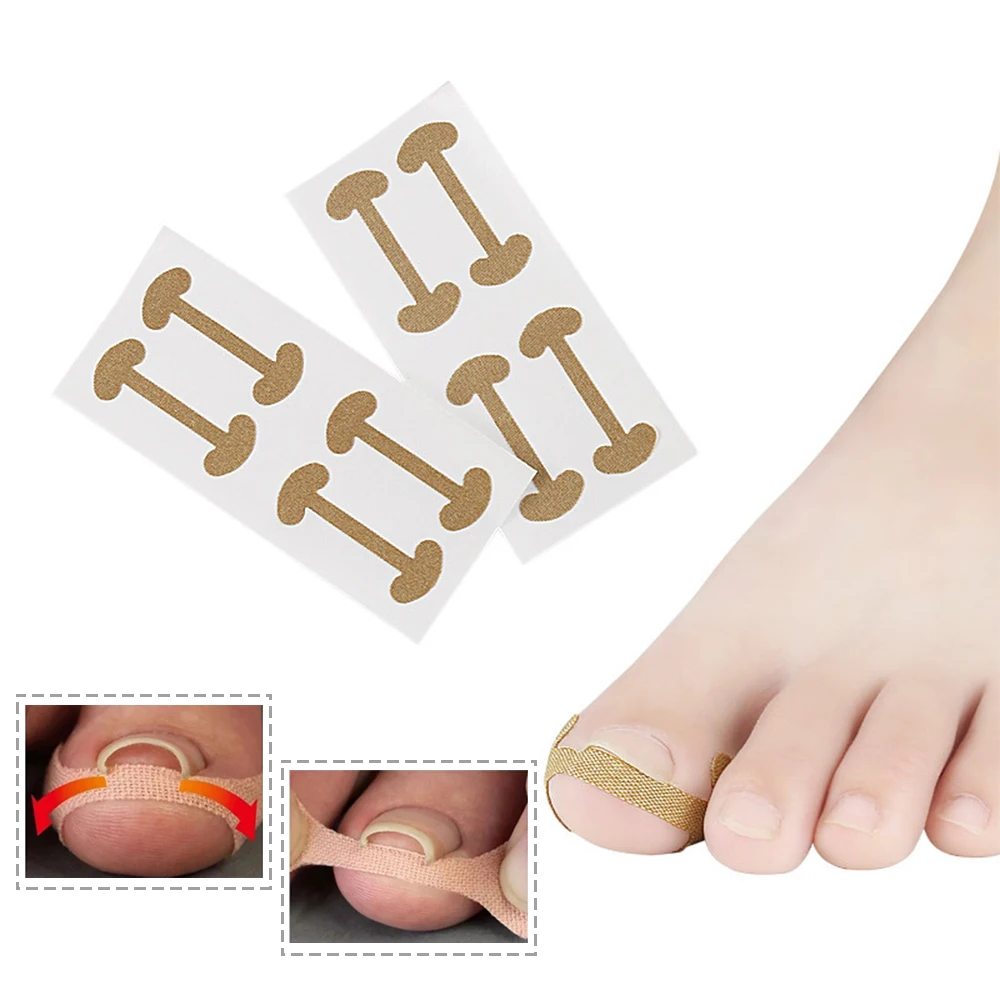 20pcs Professional Nail Care Embedded Toe Corrector Sticker Toenail Pedicure Thumb Curl Correction Foot | Красота и здоровье