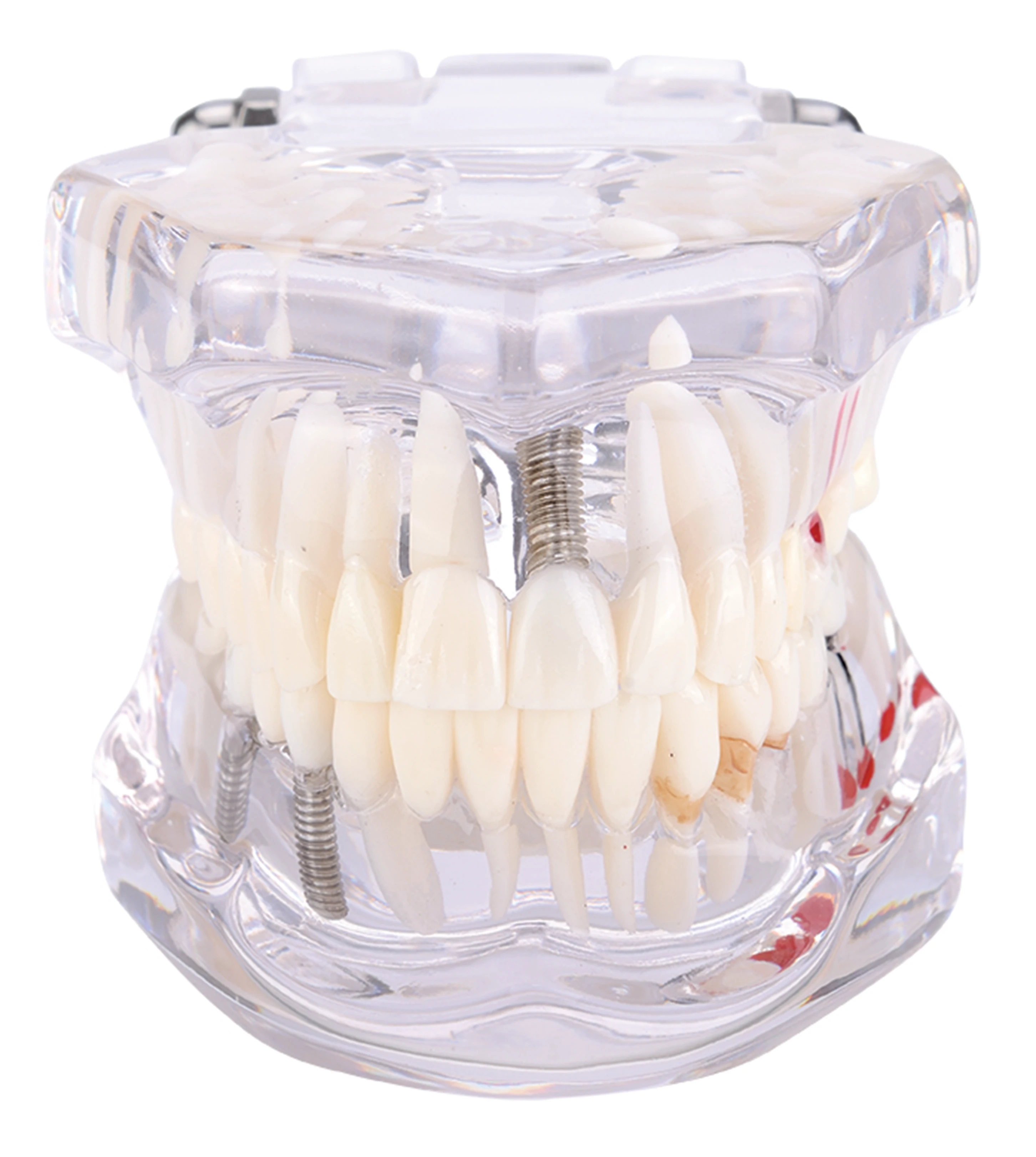 Dental Teeth Model Restoration Implant Tooth Model Clear Transparent color Hospital Clinic Dentist Needs Models Laboratory Study
Dental Teeth Model Restoration Implant Tooth Model Clear Transparent color Hospital Clinic Dentist Needs Models Laboratory Study