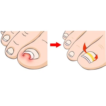 Ingrown Toe Nail Correction Sticker Patch Paronychia Correction File Acronyx Wire Corrector Foot Care Treatment 10pcs/pack
Ingrown Toe Nail Correction Sticker Patch Paronychia Correction File Acronyx Wire Corrector Foot Care Treatment 10pcs/pack