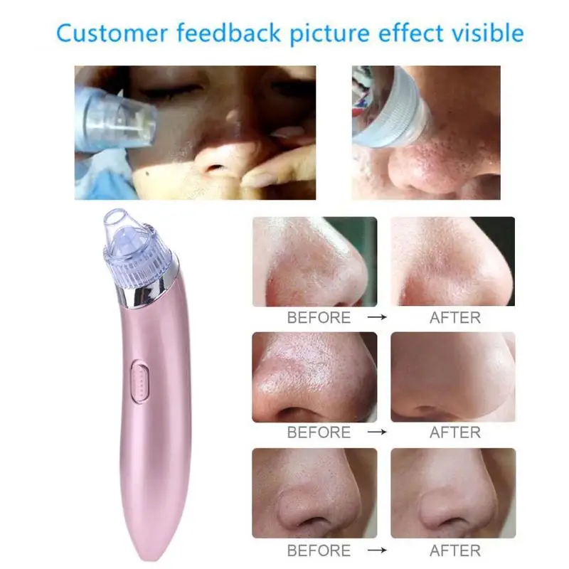 Pro Pore Clean Machine Acne Blackhead Remover Vacuum Suction Pore Clean Machine Pore Cleaner Facial Skin Care dfdf
Pro Pore Clean Machine Acne Blackhead Remover Vacuum Suction Pore Clean Machine Pore Cleaner Facial Skin Care dfdf