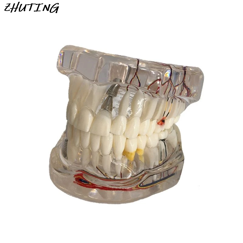 Dental Disease Implant Teeth Model with Restoration Bridge Tooth Dentist for Medical Science Teaching Study | Канцтовары для офиса