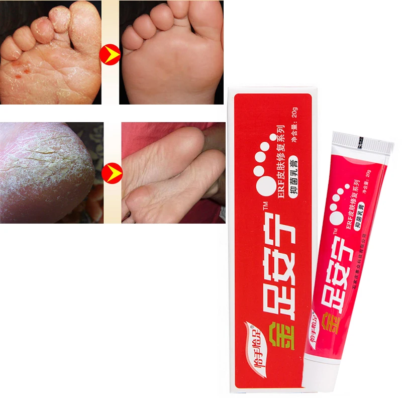 hand foot Crack Peeling Repair,Treatment hand foot Fungus itch and dry Chinese herbal medicine plaster Foot care Repair ointment 
hand foot Crack Peeling Repair,Treatment hand foot Fungus itch and dry Chinese herbal medicine plaster Foot care Repair ointment