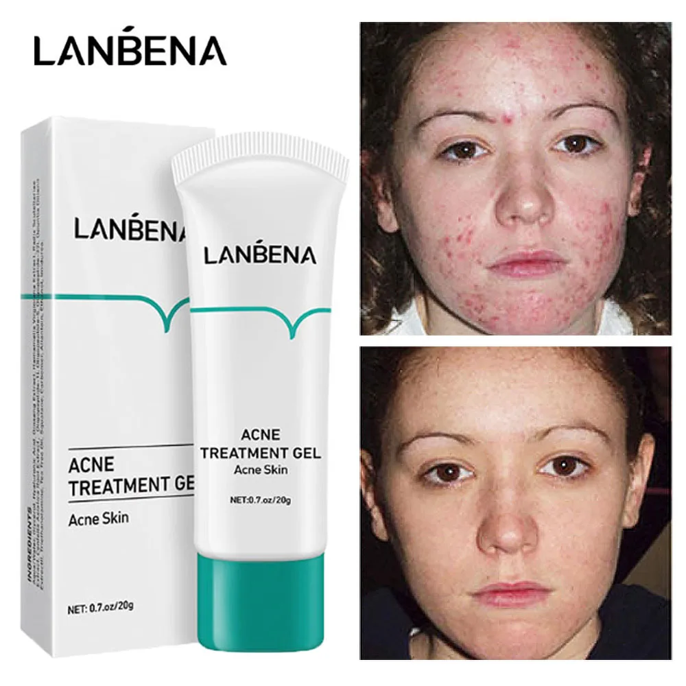 LANBENA Acne Treatment Gel Anti Acne Face Cream Scar Pimple Removal Fading Acne Marks Scar Oil Control Repair Nourish Skin Care
LANBENA Acne Treatment Gel Anti Acne Face Cream Scar Pimple Removal Fading Acne Marks Scar Oil Control Repair Nourish Skin Care