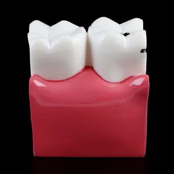 6 Times Dental Caries Comparation Anatomy Teeth Model for Dental Anatomy Lab Teaching Studying Researching Tool
6 Times Dental Caries Comparation Anatomy Teeth Model for Dental Anatomy Lab Teaching Studying Researching Tool