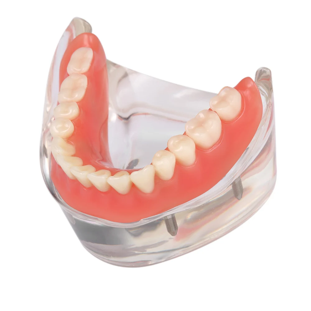 Dental Overdenture Teeth Model Interior Mandibular Lower Teeth Model Mandibular With 4 Implant Restoration Dental Teaching Study
Dental Overdenture Teeth Model Interior Mandibular Lower Teeth Model Mandibular With 4 Implant Restoration Dental Teaching Study