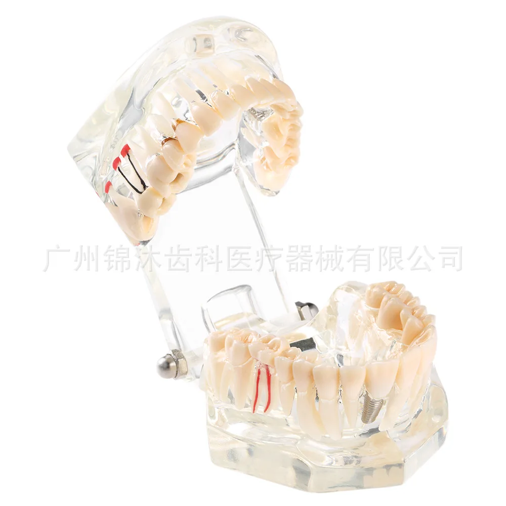 Oral Bridge Repair Model Pathological Tooth Model Activity Tooth Model Dental Implant Model
Oral Bridge Repair Model Pathological Tooth Model Activity Tooth Model Dental Implant Model