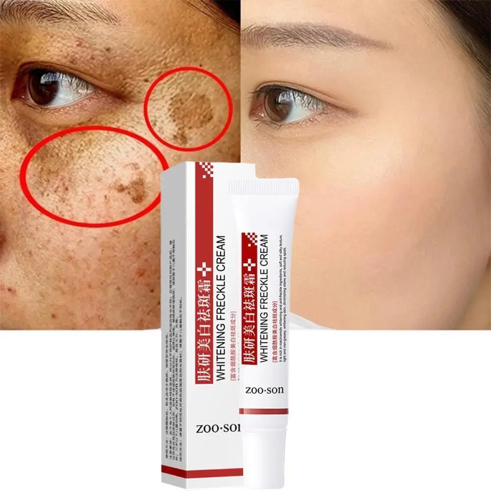 

Whitening Freckle Cream Remove Dark Spots Anti Freckle Face Creams Niacinamide Fade Pigmentation Melasma Brighten Skin Care 20g