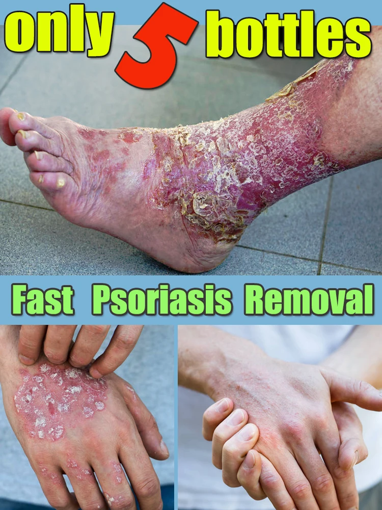 Psoriasis cream to remove psoriasis eczema Effectively repair psoriasis on all parts of the body
Psoriasis cream to remove psoriasis eczema Effectively repair psoriasis on all parts of the body