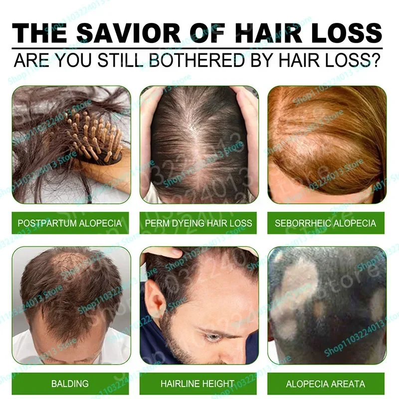 

Sdottor быстрое рост волос масло для волос лечение против выпадения волос Мужская Женская Сыворотка для лечения кожи головы продукты для красоты здоровья