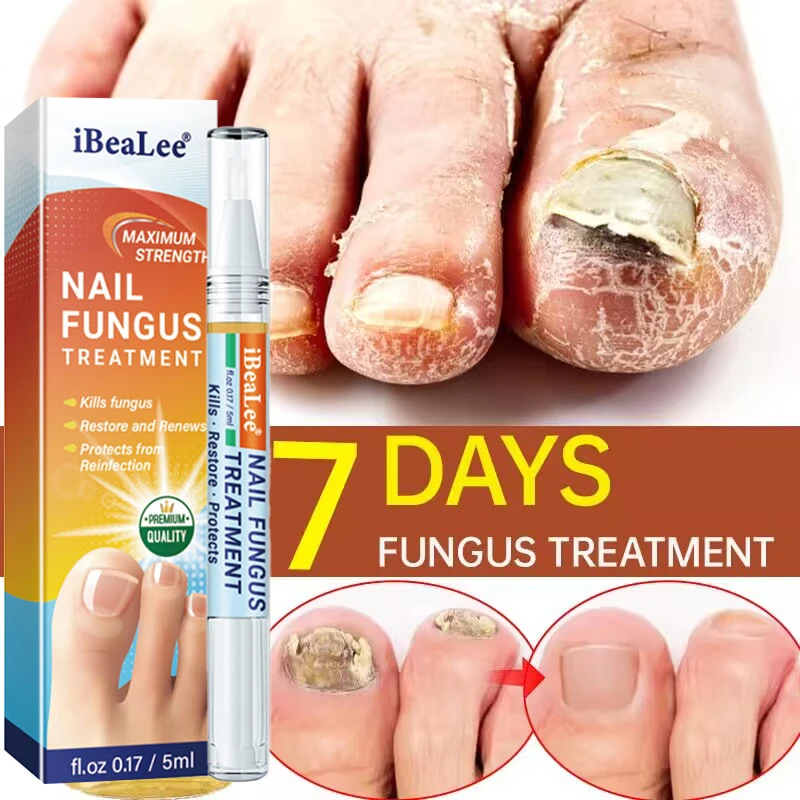 Effective Nail Fungal Treatment Serum Feet Toe Nail Fungus Remove Gel Anti Infection Paronychia Onychomycosis Nail Care Products
Effective Nail Fungal Treatment Serum Feet Toe Nail Fungus Remove Gel Anti Infection Paronychia Onychomycosis Nail Care Products
