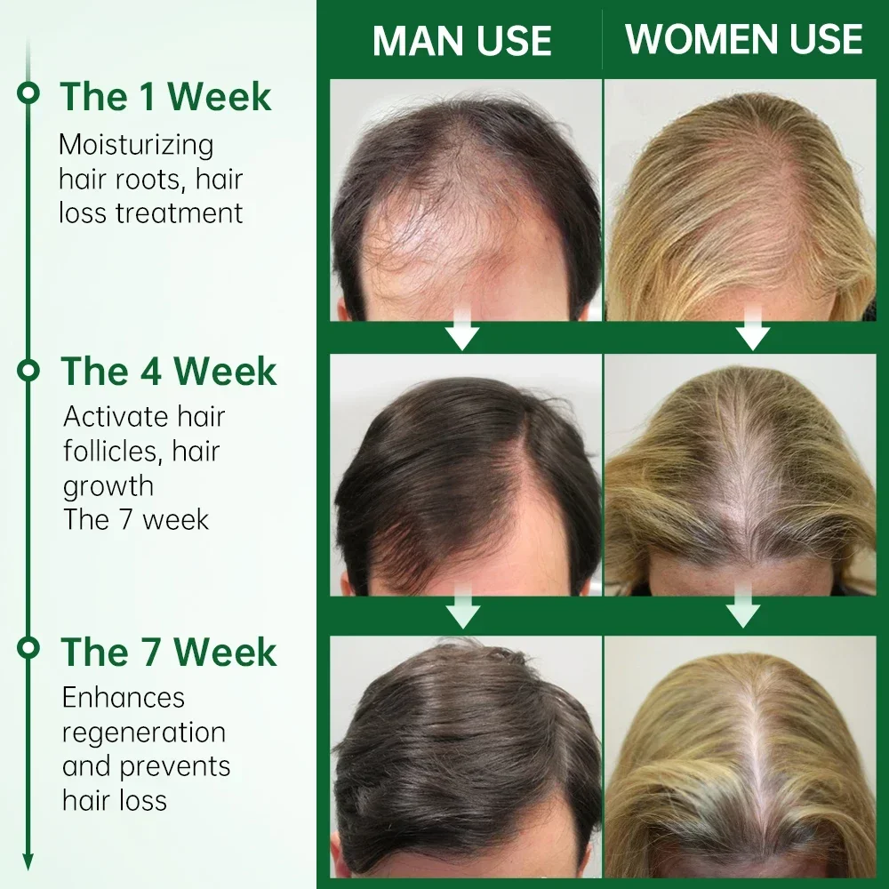 

Масло розмарина Sdotter New PURC для роста волос для мужчин и женщин, Имбирь против выпадения волос, искусственные масла для ухода за кожей головы