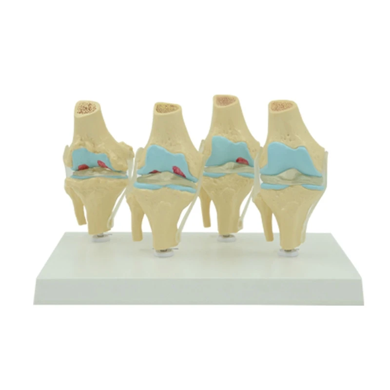 Модель скелета коленного сустава человека. Медицинское сравнение модели заболеваний коленного сустава.
Модель скелета коленного сустава человека. Медицинское сравнение модели заболеваний коленного сустава.