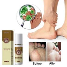 Anti Fungal Foot Spray Herbal Skin Care Remove Fungus Products Relieve Beriberi Toe Onychomycosis Treatment Nourish Feet Care
Anti Fungal Foot Spray Herbal Skin Care Remove Fungus Products Relieve Beriberi Toe Onychomycosis Treatment Nourish Feet Care