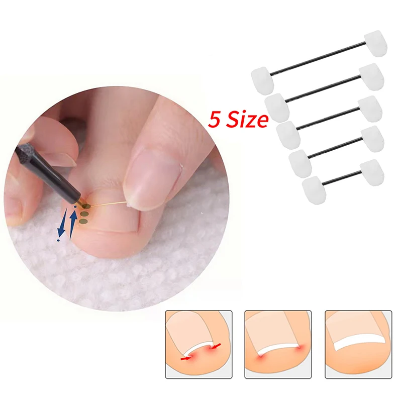 Professional Ingrown Toenail Correction Ingrown Toenail Corrector Tools Pedicure Recover Embed Toe Nail Treatment Foot Care Tool
Professional Ingrown Toenail Correction Ingrown Toenail Corrector Tools Pedicure Recover Embed Toe Nail Treatment Foot Care Tool