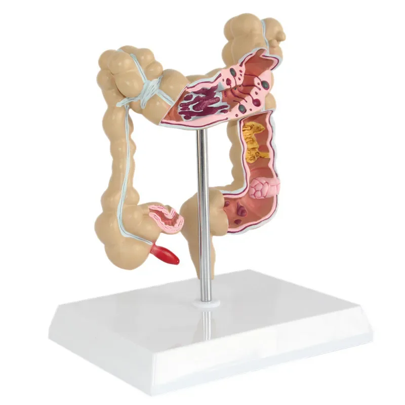 Anatomical Human Colorectal Lesion Model Anatomy Colon Diseases Intestine Medical Teaching Learning Supplies Tool
Anatomical Human Colorectal Lesion Model Anatomy Colon Diseases Intestine Medical Teaching Learning Supplies Tool