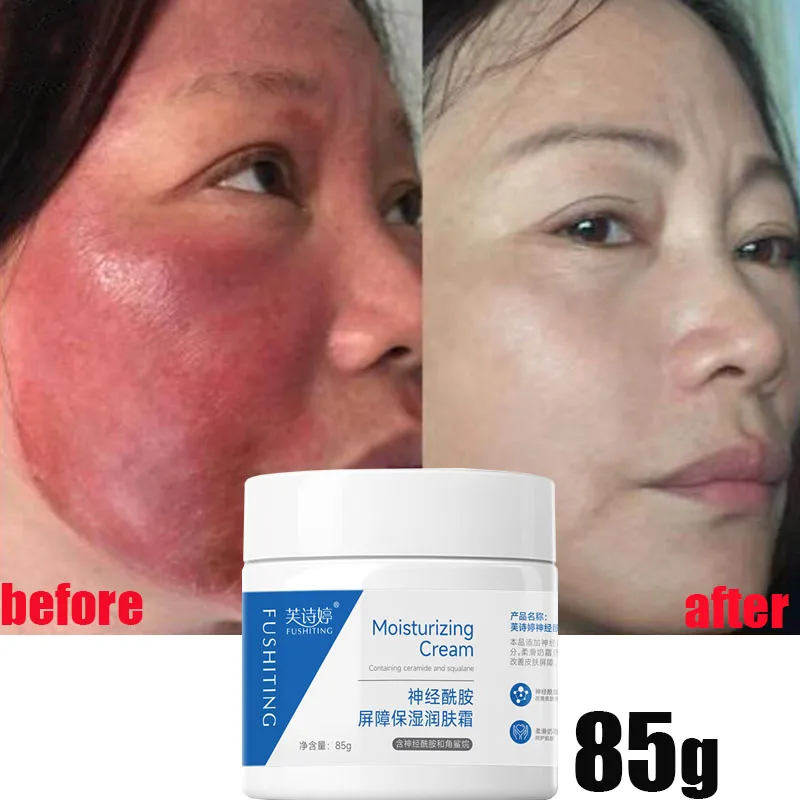 Facial Redness Treatment Cream Instant Rosacea Red Blood Repair Pruducts Anti Redness Spider Vein Sensitive Skin Barrier Care
Facial Redness Treatment Cream Instant Rosacea Red Blood Repair Pruducts Anti Redness Spider Vein Sensitive Skin Barrier Care