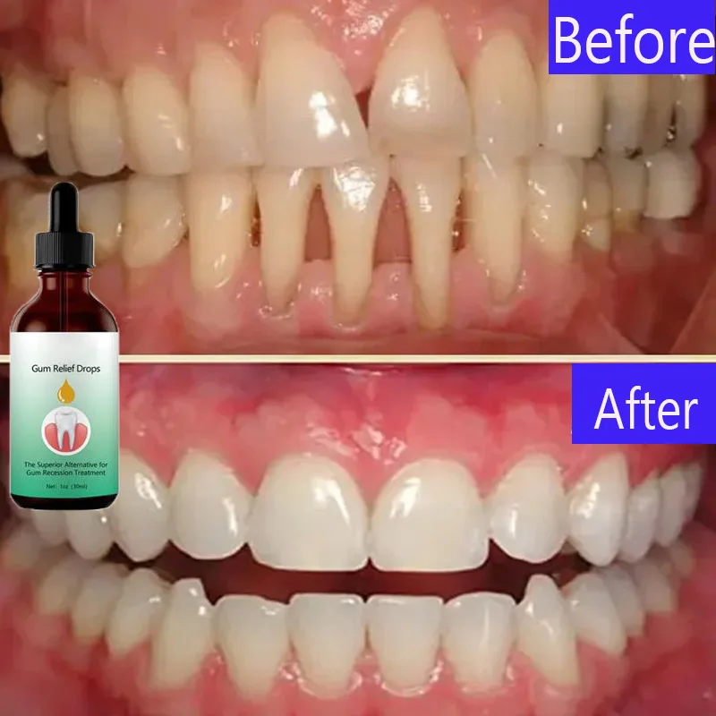 Gingival Regrowth Drops Quickly Repair Of Cavities Caries Serum Gum Treatment For Receding Gums Rejuvenate Your Gums With Ease
Gingival Regrowth Drops Quickly Repair Of Cavities Caries Serum Gum Treatment For Receding Gums Rejuvenate Your Gums With Ease
