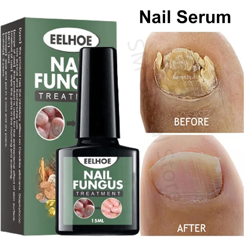 Эффективная Сыворотка для лечения грибка ногтей средство для удаления грибка ногтей против инфекции паронихия онихомикоз Восстанавливающий уход
Эффективная Сыворотка для лечения грибка ногтей средство для удаления грибка ногтей против инфекции паронихия онихомикоз Восстанавливающий уход