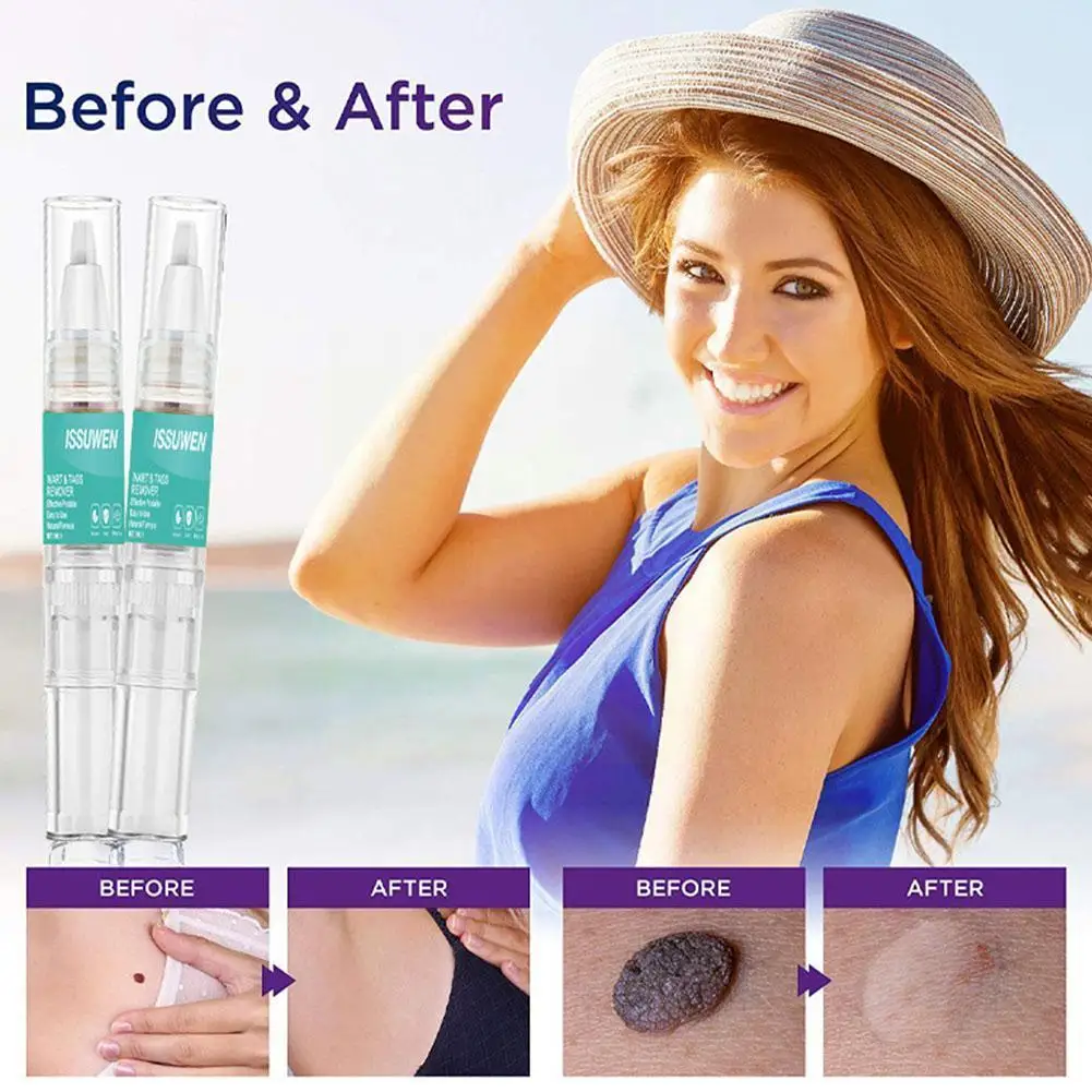 Skin Tag Remover Against Mole & Genital Wart Skin Dark Freckle Serum Spot Blemish Antiacne Face Tag Removal Wart Remover Wa E9S0
Skin Tag Remover Against Mole & Genital Wart Skin Dark Freckle Serum Spot Blemish Antiacne Face Tag Removal Wart Remover Wa E9S0