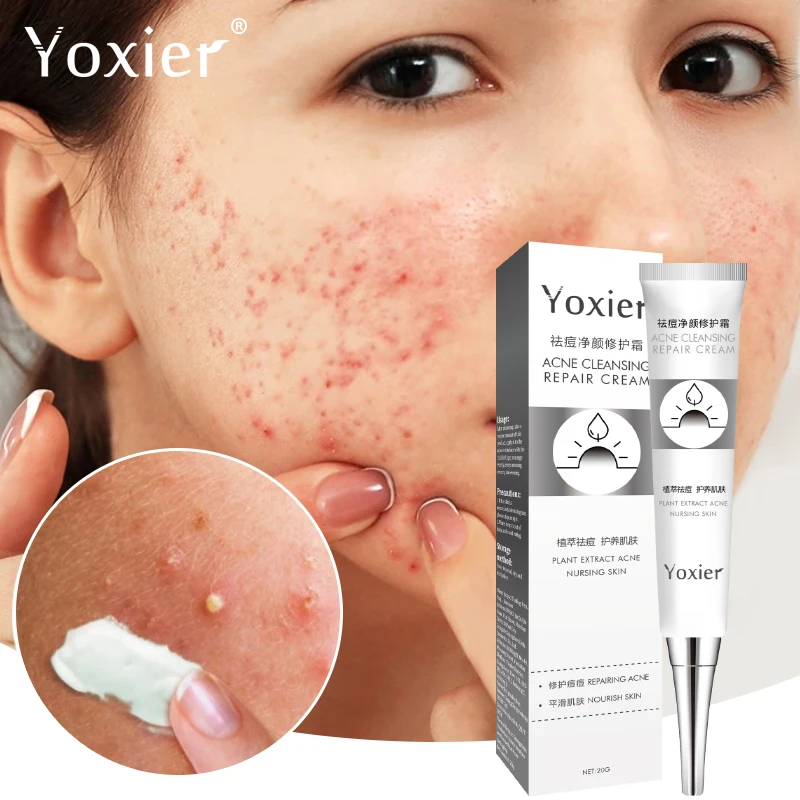 Acne Repair Cream Remove Acne Fade Acne Marks Oil-control Repair Skin Brighten Skin Tighten Pores Hyaluronic Acid Skin Care 20g
Acne Repair Cream Remove Acne Fade Acne Marks Oil-control Repair Skin Brighten Skin Tighten Pores Hyaluronic Acid Skin Care 20g
