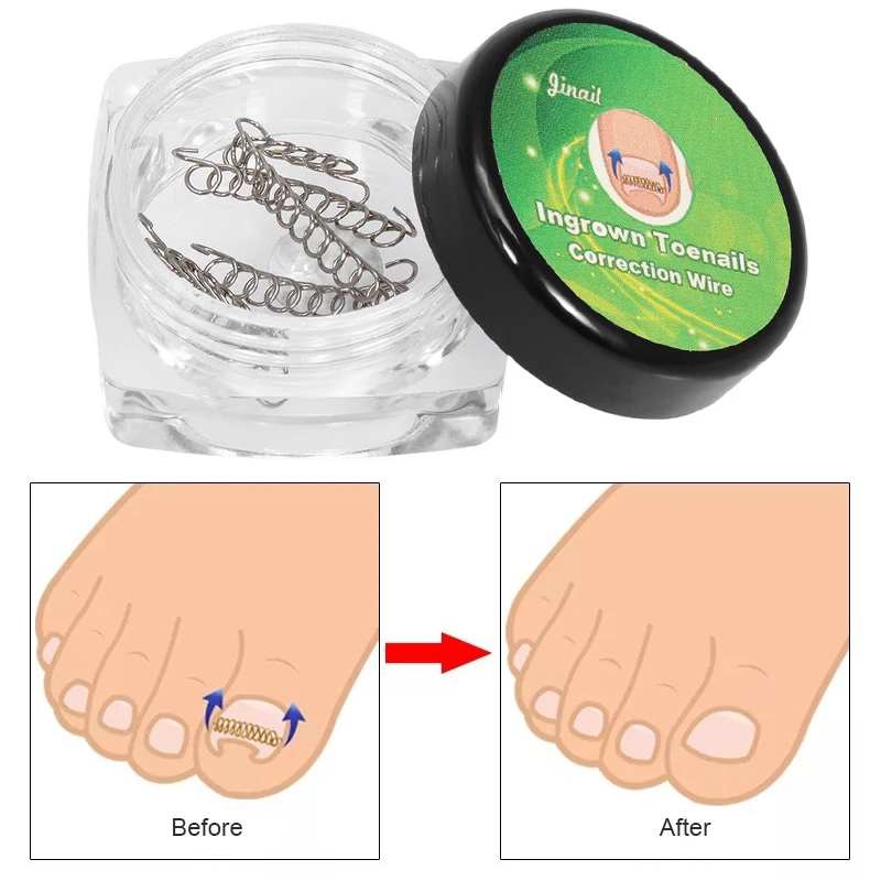 Ingrown Toenail Correction Tool Invisible Ingrown Toe Nail Elastic Straightening Clip Brace Pedicure Tool
Ingrown Toenail Correction Tool Invisible Ingrown Toe Nail Elastic Straightening Clip Brace Pedicure Tool