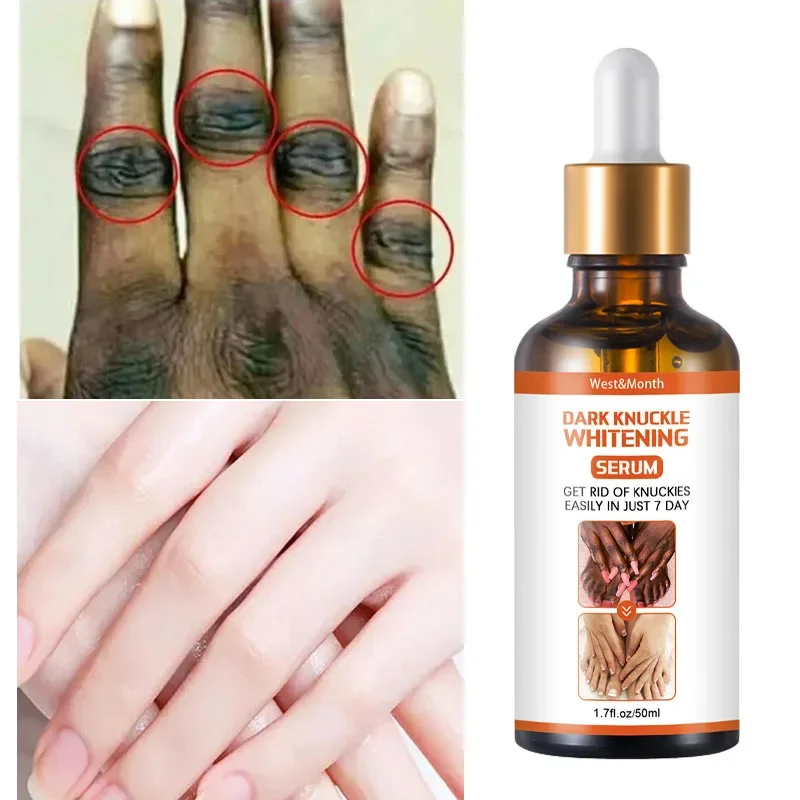 Dark Knuckles Fast Whitening Serum Hand Knuckle Elbows Knee Melanin Corrector Intense Stains Remover Products Beauty Care 50ml
Dark Knuckles Fast Whitening Serum Hand Knuckle Elbows Knee Melanin Corrector Intense Stains Remover Products Beauty Care 50ml